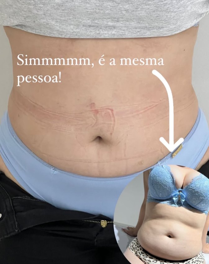 Antes e depois de tratamento corporal no abdômen da mesma paciente