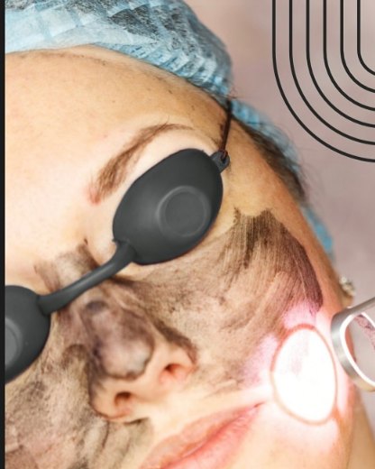 Paciente recebendo peeling a laser com óculos de proteção